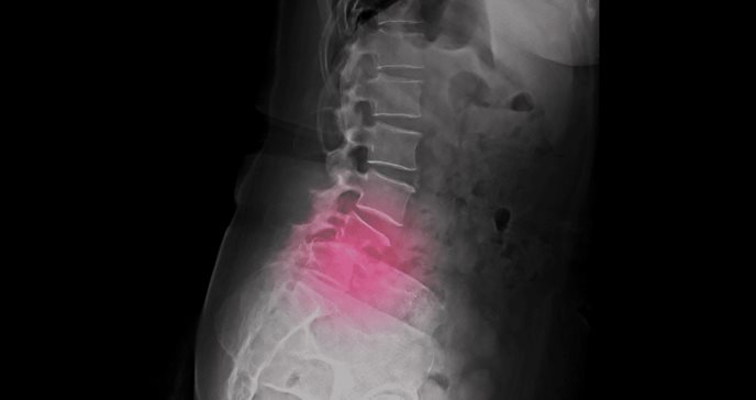 Espondilolistesis y desplazamiento de vértebras: del dolor de espalda a la intervención quirúrgica