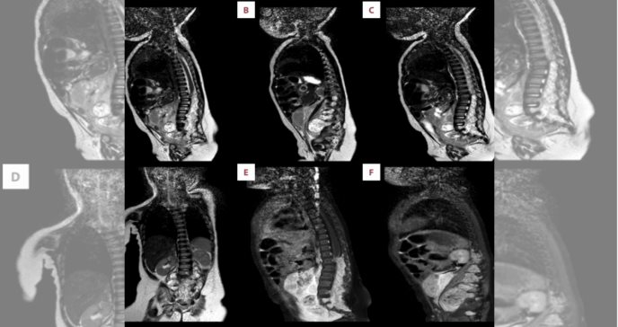Raro caso de tumor fibroso solitario/hemangiopericitoma espinal primario en niña de 9 meses