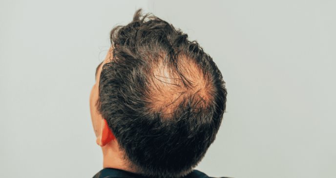 Medicamentos usados en la alopecia, como Minoxidil, ligados a mayor riesgo de depresión