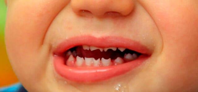 Sífilis congénita y las alteraciones dentales que genera