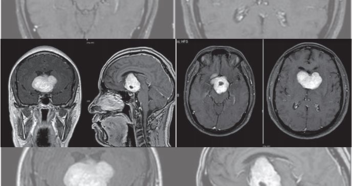 Paciente con psicosis desarrolla glioma cordoide, un tumor cerebral poco frecuente