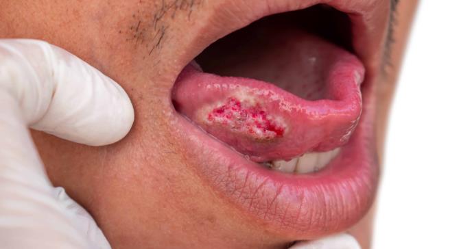 El trasfondo del cáncer de lengua, según un estudio puertorriqueño