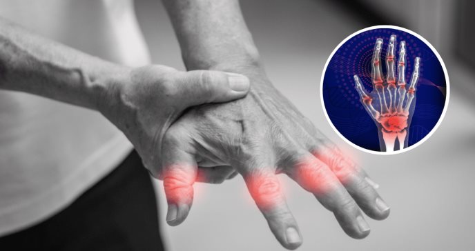 Artrosis erosiva de las manos, más discapacitante y aguda que la misma artrosis
