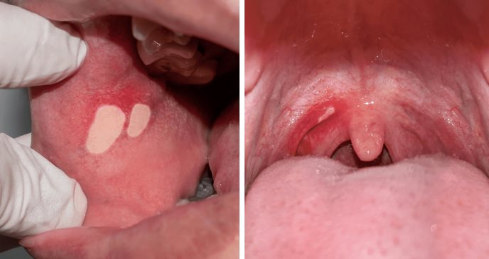 Principales infecciones y lesiones del sexo oral en nariz, oídos o garganta