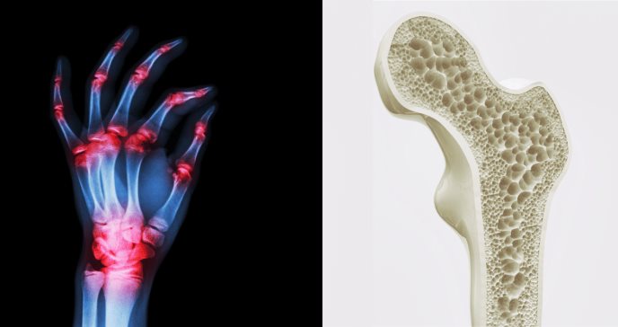 Datos claves sobre la relación entre artritis y osteoporosis