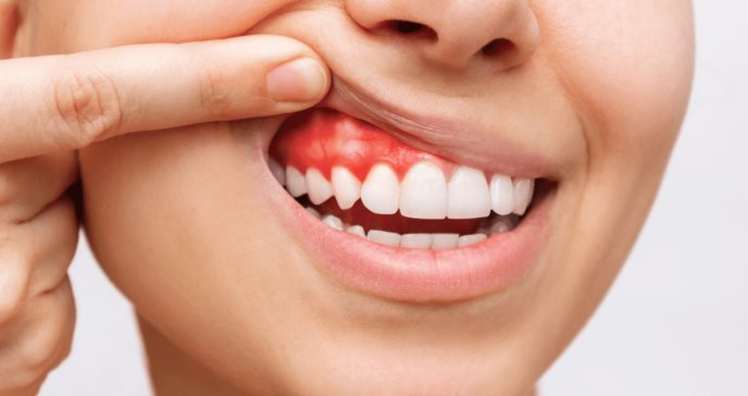 Hipersensibilidad dentinaria debido a caries, blanqueamientos o desgaste del esmalte dental