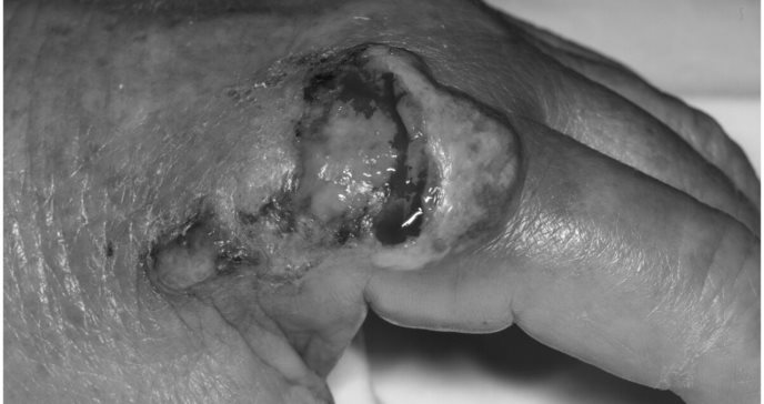 Dermatosis neutrofílica de las manos se asocia con neoplasias malignas y enfermedades pulmonares