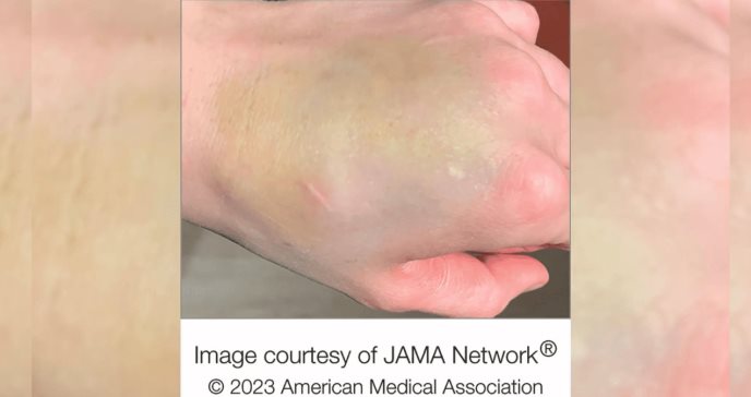 Extraño moretón verde azulado en la mano resulta ser un raro tumor de crecimiento lento