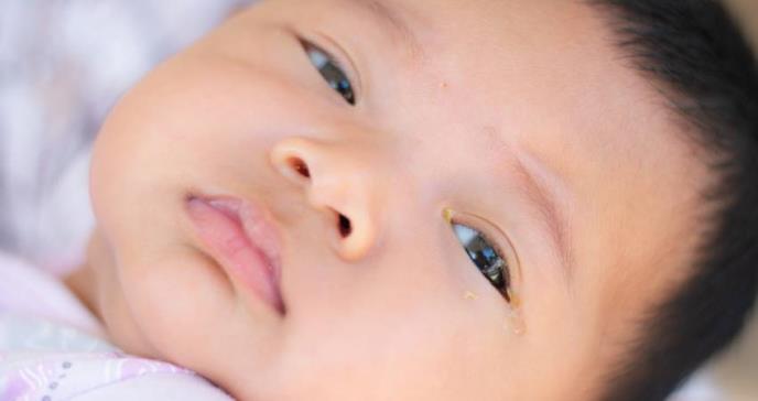 Todo lo que debes saber de la obstrucción del conducto lagrimal en bebés