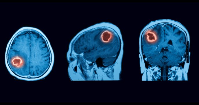 Cuidado con los golpes en la cabeza: Traumatismos craneales pueden desencadenar cáncer cerebral
