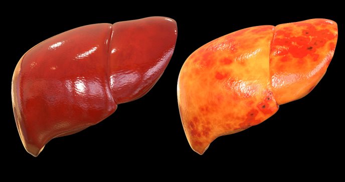 Hígado graso: ¿puede desencadenar cirrosis o hepatitis alcohólica?