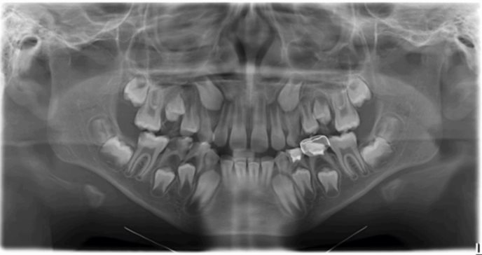 Extraen inusual diente canino maxilar primario con dos raíces a un niño de 9 años