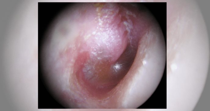 Miringotomía, intervención efectiva para drenar pus del oído debido a otitis o infecciones recurrentes