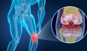 Estudio comprueba que el dolor de rodilla causado por la edad disminuye con terapia no quirúrgica