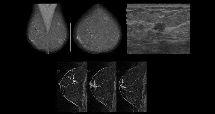 El impacto de la resonancia magnética mamaria en la cirugía oncoplástica y en indicaciones de mastectomía