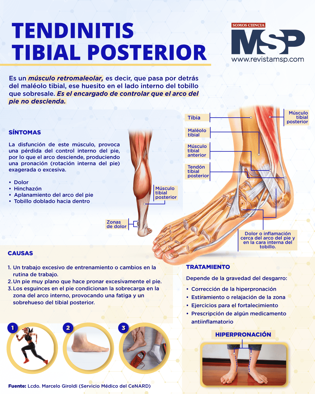 Tendinitis Tibial Posterior Infografía 0519