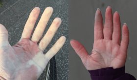 Fenómeno de Raynaud y acrocianosis: diferencias entre la coloración de los dedos de manos y pies