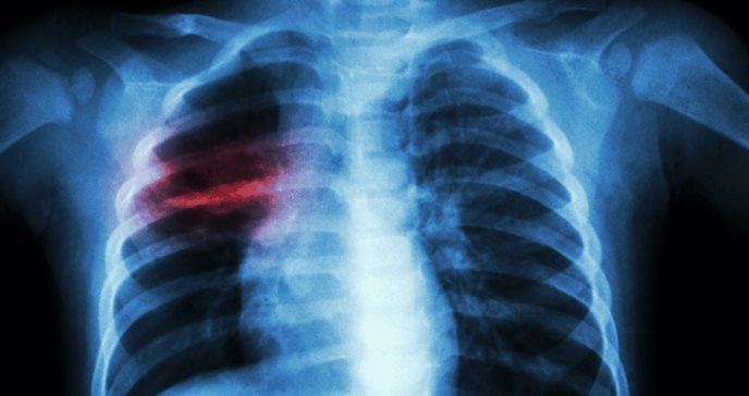 Tuberculosis en niños de Latinoamérica: un desafío de salud pública que aún persiste