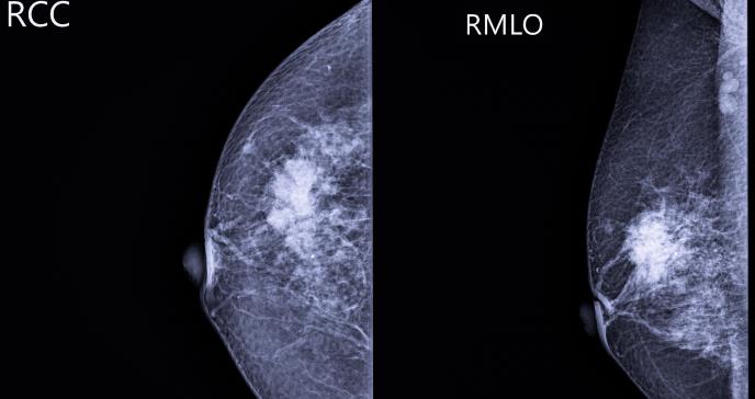 ¿Qué significa tener mamas o senos densos en mamografías y cuál es su relación con el cáncer?