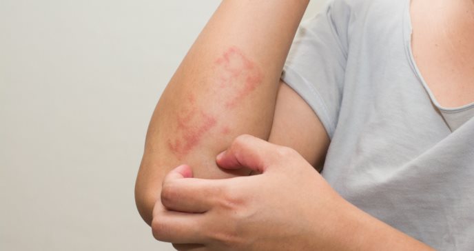 FDA amplía aprobación de CIBINQO® para el tratamiento de la dermatitis atópica en mayores de 12 años
