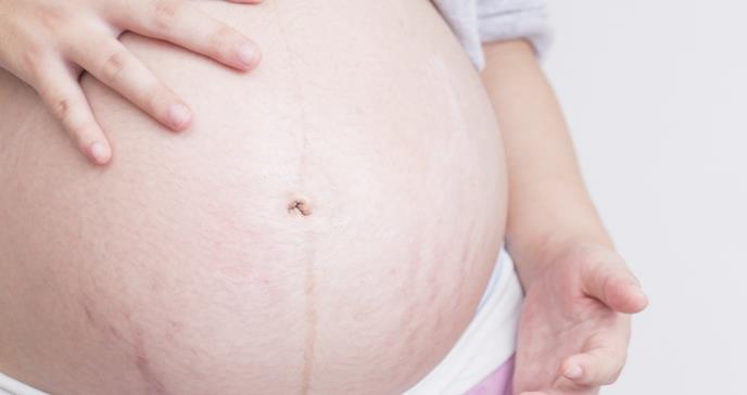 Estrías en el embarazo ¿Cómo prevenirlas?