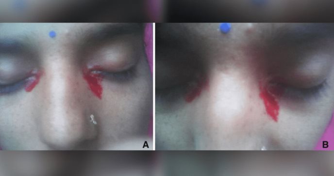 Hemolacria: el inusual caso de una mujer que lloró sangre por menstruación vicaria ocular