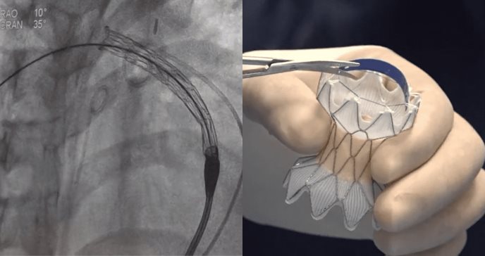 Paciente pediátrica con cardiopatía congénita recibe primer reemplazo de válvula pulmonar transcatéter