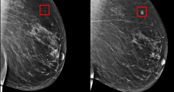 Inteligencia artificial sería capaz de predecir el cáncer de mama hasta 4 años antes de que se desarrolle