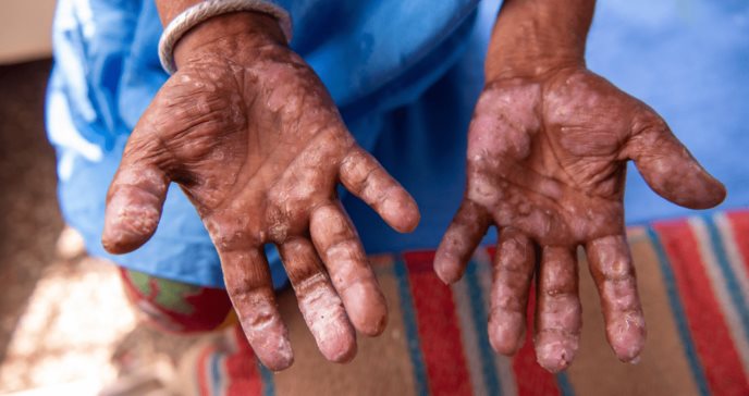 Lepra, la enfermedad ancestral que sigue siendo un problema en la era moderna