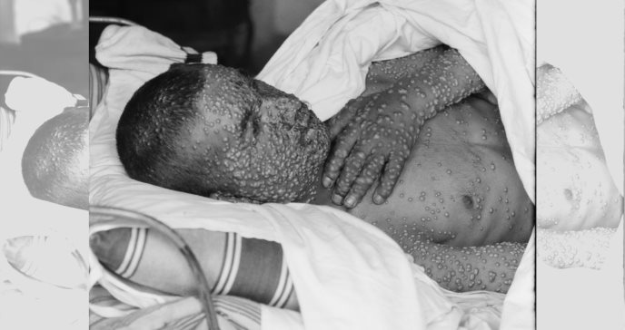 Viruela: la enfermedad que afectó por milenios a los humanos y fue erradicada en 1980