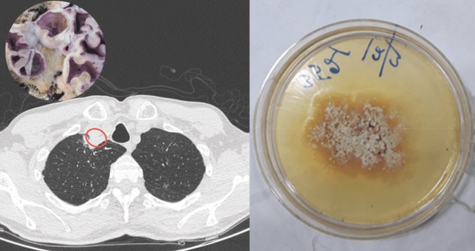 Primer humano infectado por el hongo Chondrostereum purpureum que se creía sólo afectaba a plantas