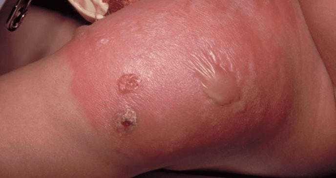 Celulitis bacteriana y la piel edematosa, caliente o con ampollas