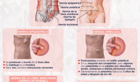 Hernias de la pared abdominal - Infografía