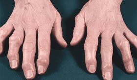 Artrosis erosiva de las manos, más discapacitante y aguda que la misma artrosis