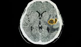 Glioma pontino intrínseco: desarrollan una nueva terapia potencial para tratar este letal tumor cerebral