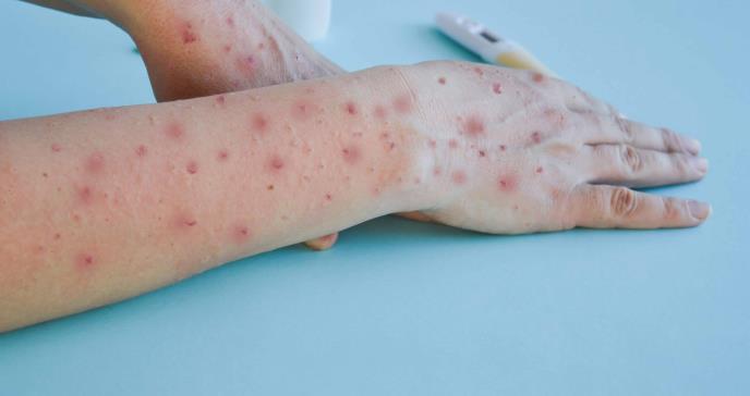 "Inmunidad en red": La protección natural que ha frenado el brote mundial de la Mpox