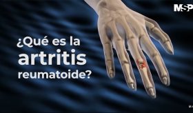 ¿Qué es la artritis reumatoide? #ExclusivoMSP