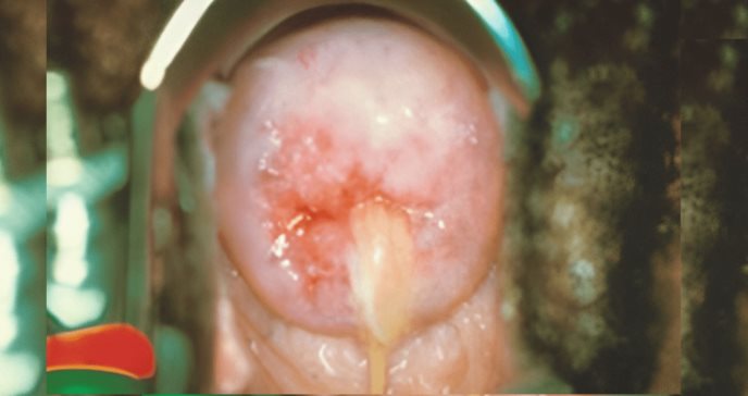 Micoplasma genital: Infección de Transmisión Sexual poco conocida que se asocia con cervicitis en mujeres