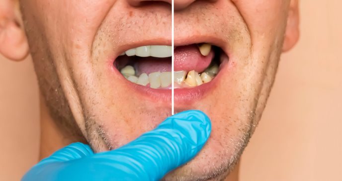 Caries y enfermedad periodontal: los dientes no sólo se caen por el abuso de azúcar