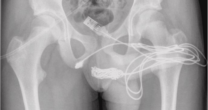 Joven hospitalizado tras introducirse un cable USB para "medir" el interior de su pene