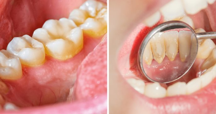¿Cuál es la diferencia entre la placa dental y el sarro?