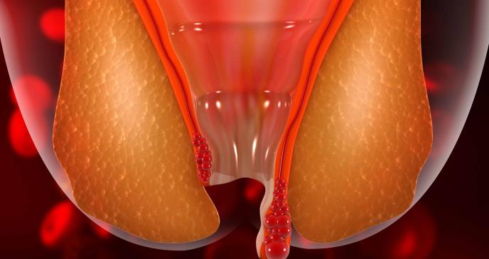 Sangrado, dolor o incontinencia al defecar: conoce las 4 fases de las hemorroides o almorranas