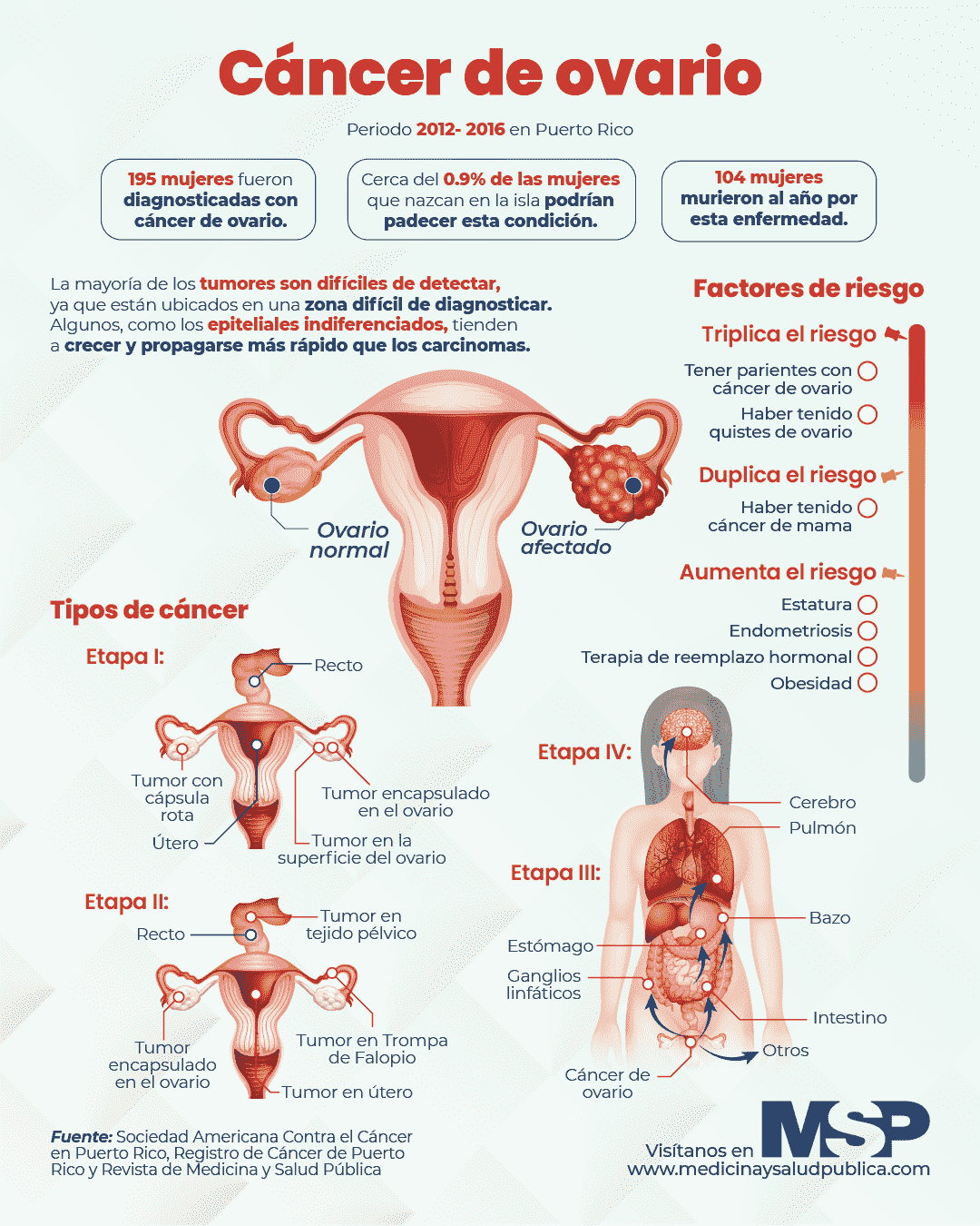 Cáncer De Ovario Infografía 9717