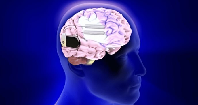Marcapasos cerebral minimiza convulsiones en pacientes con epilepsia resistente a fármacos