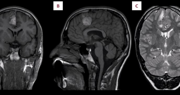 Melanoma cerebral primario en una paciente pediátrica puertorriqueña