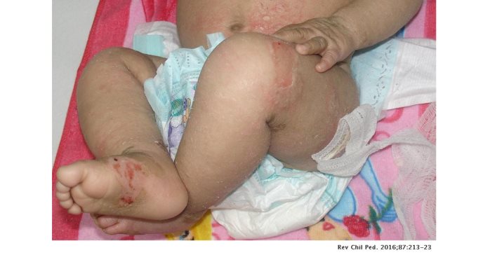Ictiosis epidermolítica, la dolorosa enfermedad congénita que hace crecer la piel excesivamente rápido