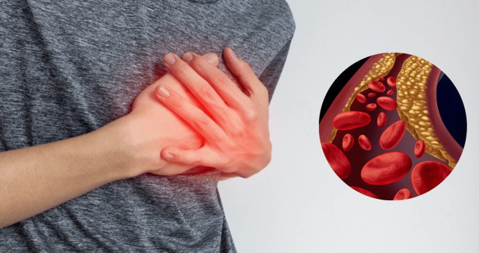Colesterol remanente podría ser un factor de riesgo en el infarto agudo de miocardio, según estudio
