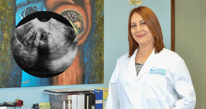 Estudio revela alta prevalencia de fibromas uterinos en mujeres puertorriqueñas