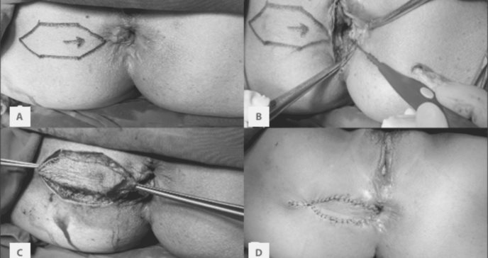 Reparación anal con colgajo de diamante en mujer de 57 años, tras dos años de cirugía hemorroidectomía
