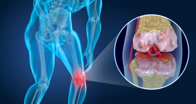 El potencial del trasplante de células madre para tratar la artrosis de rodilla